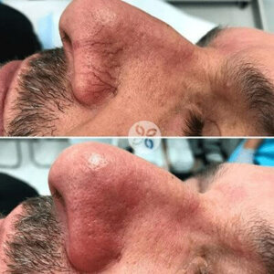 Laser for Veins Before and After