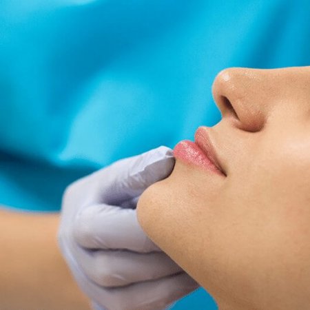 Lip Filler Treatment