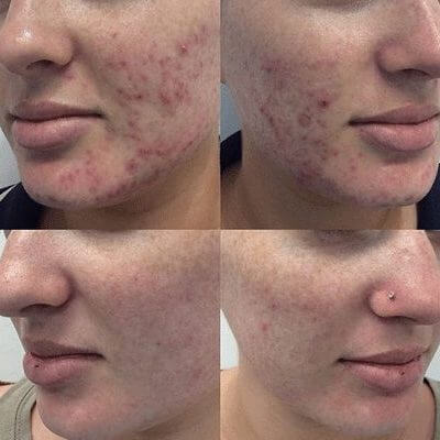 Medi-Aesthetic Peels Before and After 1 Medi-Aesthetic Peels Before and After 1