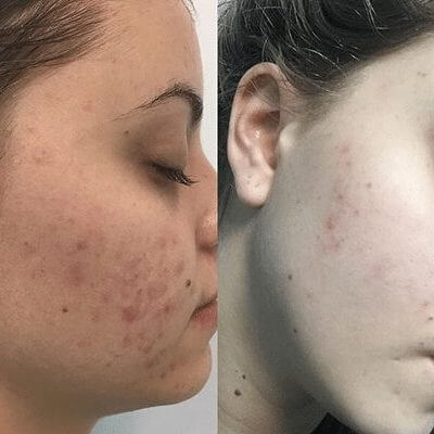 Medi-Aesthetic Peels Before and After 2 Medi-Aesthetic Peels Before and After 2