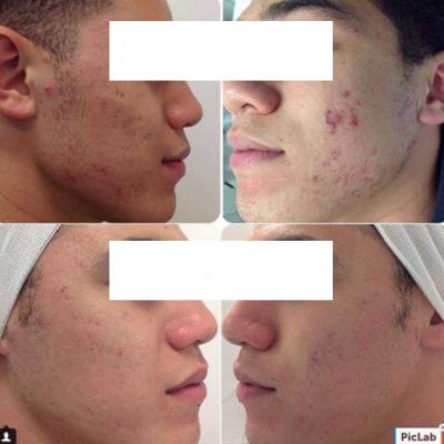 Acne Before & After copy